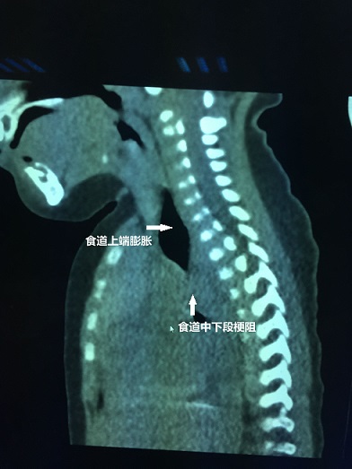 CT片显示梗阻.jpg